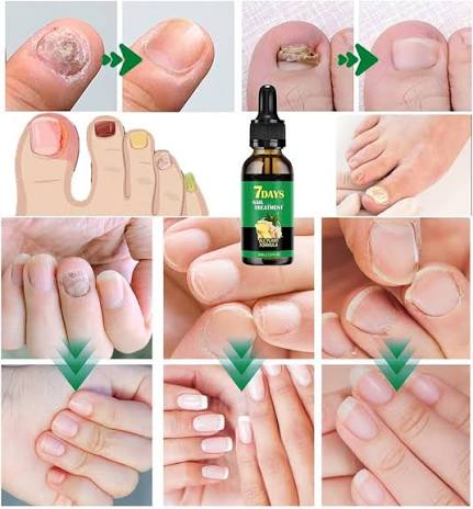 7 days Nail Treatment,Nail Serum & Cuticle Care Oil (Pack of 2)